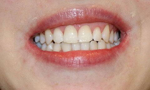 wybielanie zębów, efekty
