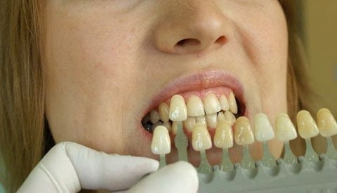 wybielanie zębów, wybieranie koloru