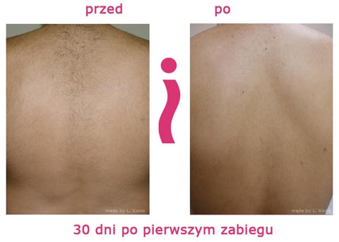 EpilFree, depilacja pleców