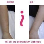przed-i-po-przedramie.jpg