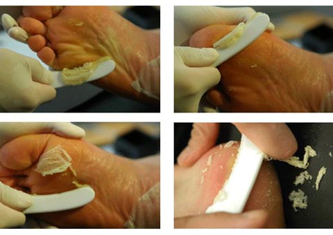 Callus Peel