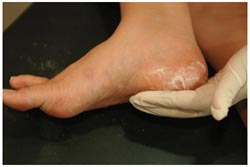 Callus Peel, krem do stóp