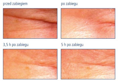 Leorex, efekty, przed zabiegiem, po zabiegu