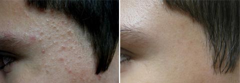 Acleara, usuwanie trądziku