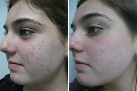 Acleara, zabiegi na trądzik, usuwanie trądziku