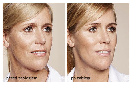 Emervel, Restylane, wypełniacze z kwasem hialuronowym, skin boosters, zabiegi medycyny estetycznej, rewitalizacja twarzy
