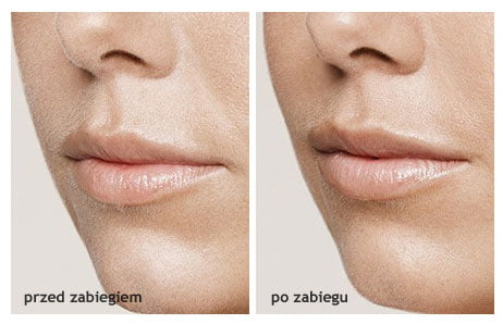 Emervel, Restylane, wypełniacze z kwasem hialuronowym, skin boosters, zabiegi medycyny estetycznej, powiększanie ust, wypełniacze do ust