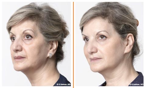 Efekty laterofacial, zabieg na szyję, StylAge