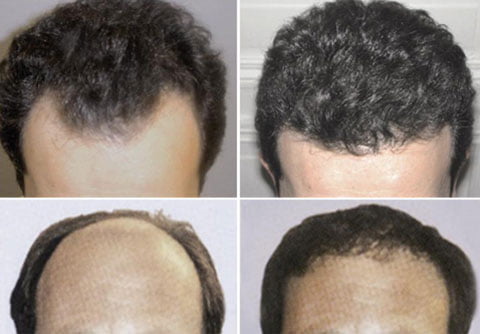 SAFER efekty przeszczepu włosów