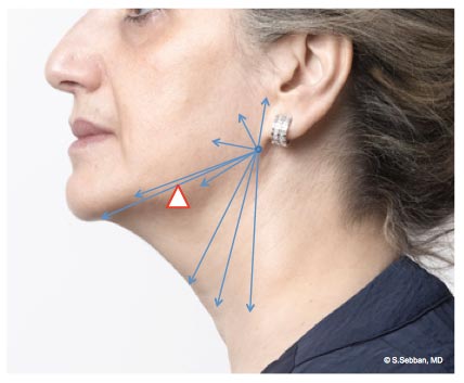laterofacial, StylAge, zabieg na szyję