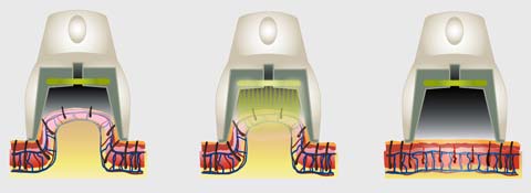Epilira, epilacja laserowa