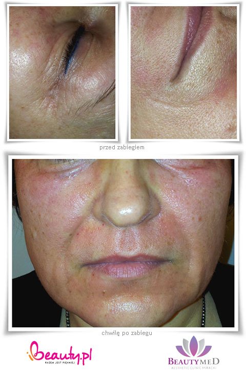 Infini termolifting efekty