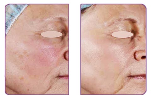 laser Emerge, efekty zabiegu