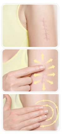 Contratubex, jak usunąć blizny