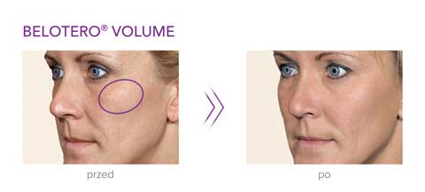 Belotero przed po