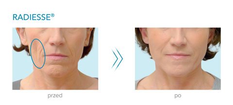 Radiesse przed po